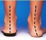 Orthotic Perscriptions