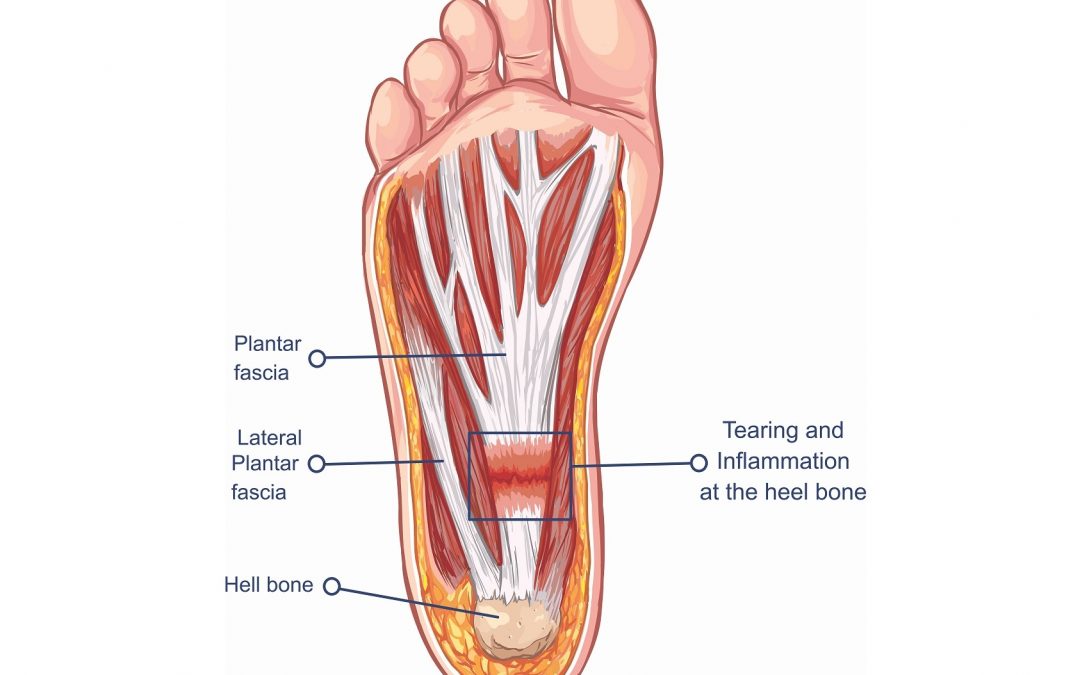 Treating Plantar Fasciitis (With a High Load Strength Training Program)