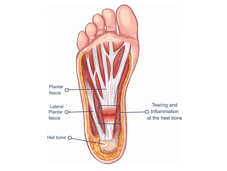 Treating Plantar Fasciitis (With a High Load Strength Training Program)