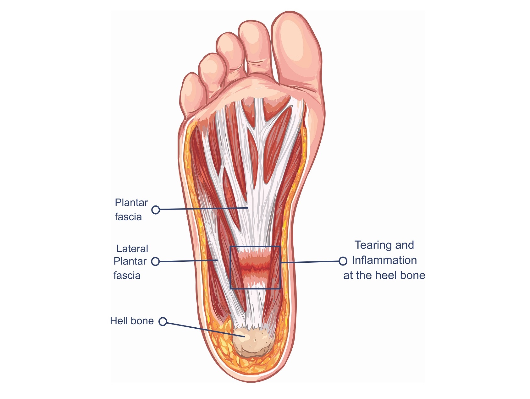 stiff plantar fascia